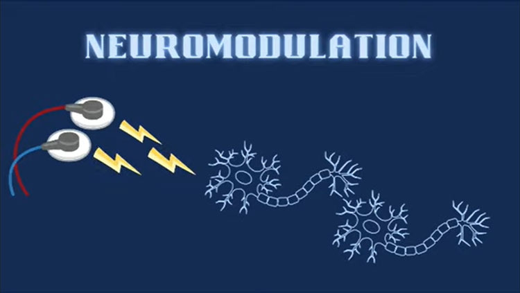 Neuromodulation 