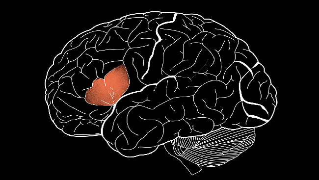 Struggling to Speak: The Brain Map of Patient Tan